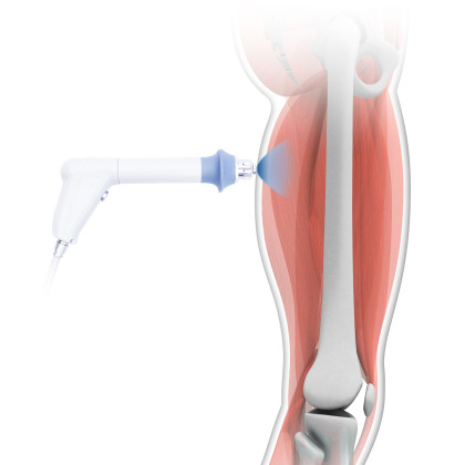 BTL-6000 SWT EASY аппарат ударно-волновой терапии Фото товара BTL-6000 SWT EASY аппарат ударно-волновой терапии