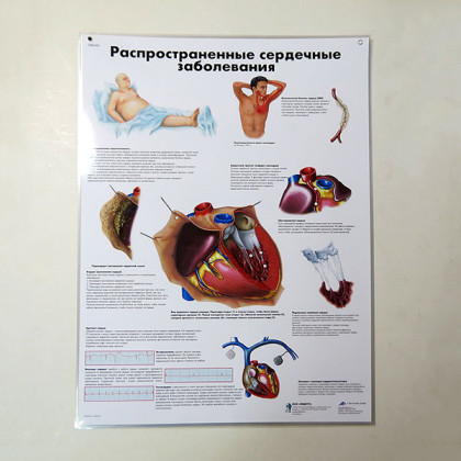 Фото товара Плакат Распространенные сердечные заболевания ламинированный