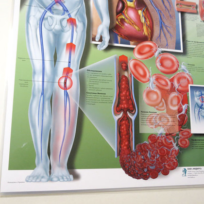 Плакат Тромбоз глубоких вен ламинированный Фото товара Плакат Тромбоз глубоких вен ламинированный