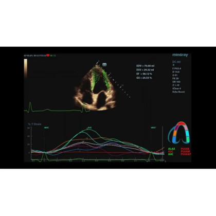 УЗИ аппарат Mindray DC-80 Фото товара УЗИ аппарат Mindray DC-80