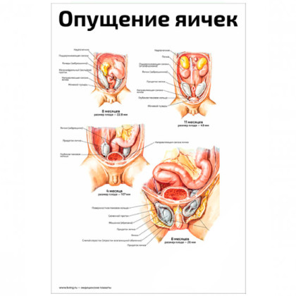 Фото товара Опущение яичек — медицинский плакат