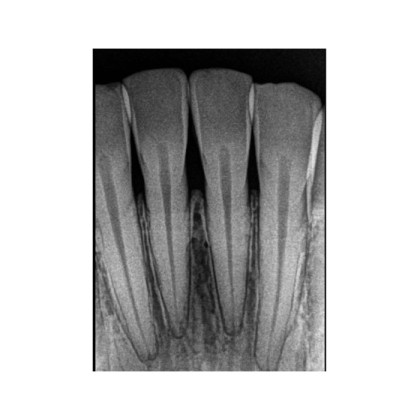 Фото товара Carestream Dental RVG 5200 - радиовизиограф, 16 пар линий/мм