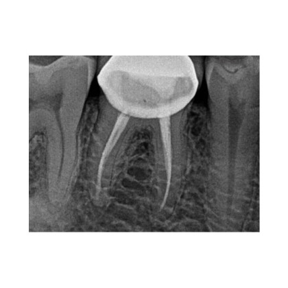 Фото товара Carestream Dental RVG 5200 - радиовизиограф, 16 пар линий/мм