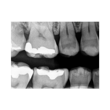 Фото товара Carestream Dental RVG 5200 - радиовизиограф, 16 пар линий/мм