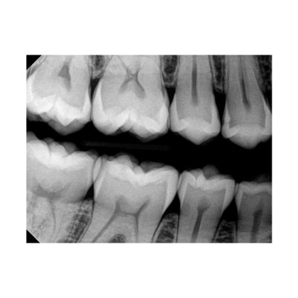 Фото товара Carestream Dental RVG 6200 - радиовизиограф, 24 пар линий/мм