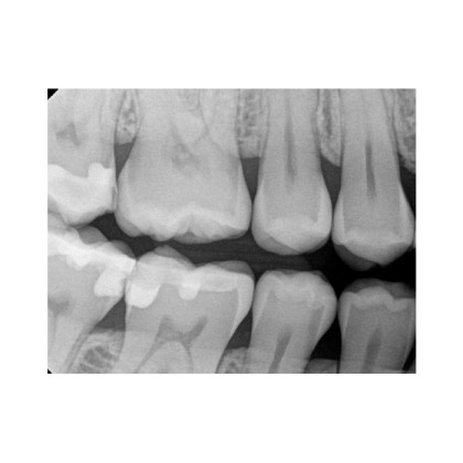 Фото товара Carestream Dental RVG 6200 - радиовизиограф, 24 пар линий/мм