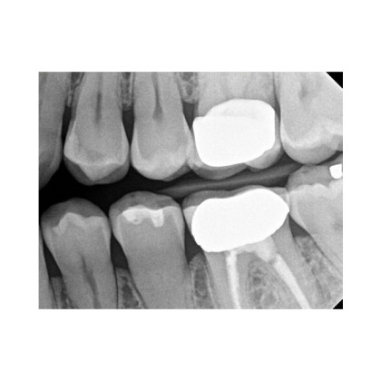 Фото товара Carestream Dental RVG 6200 - радиовизиограф, 24 пар линий/мм