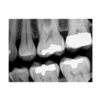 Фото товара Carestream Dental RVG 6200 - радиовизиограф, 24 пар линий/мм