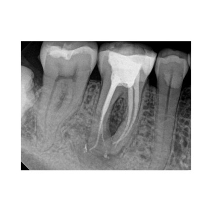 Фото товара Carestream Dental RVG 6200 - радиовизиограф, 24 пар линий/мм