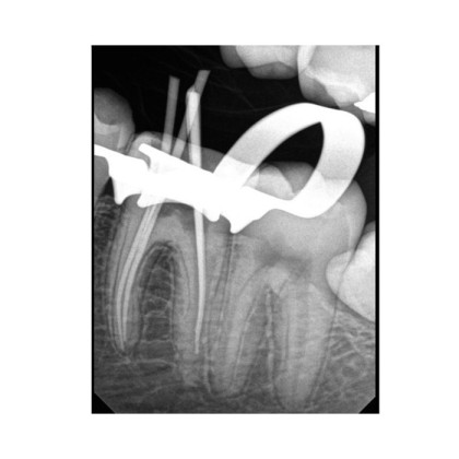 Фото товара Carestream Dental RVG 6200 - радиовизиограф, 24 пар линий/мм