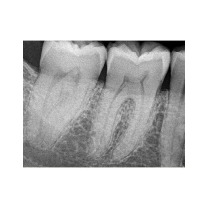 Фото товара Carestream Dental RVG 6200 - радиовизиограф, 24 пар линий/мм