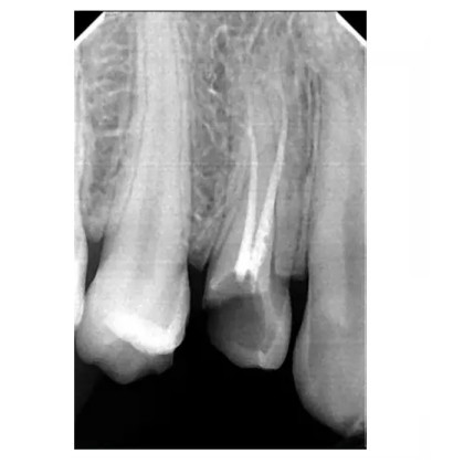 Фото товара Dexcowin DX-3000 + I-VIEW - высокочастотный портативный дентальный рентген с радиовизиографом (Корея)