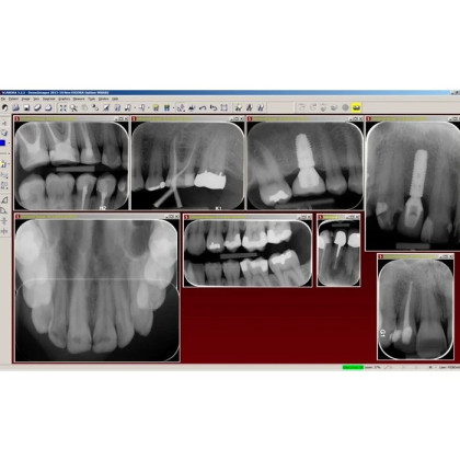 Digora Optime Classic - беспроводной визиограф в комплекте с 6-ю тонкими датчиками размера 31x41 мм Фото товара Digora Optime Classic - беспроводной визиограф в комплекте с 6-ю тонкими датчиками размера 31x41 мм