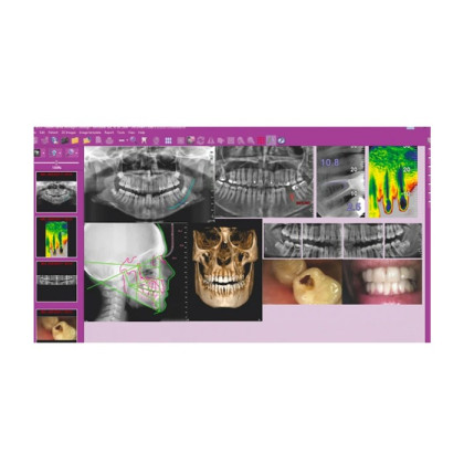 Hyperion X9 Pro 11x13 Ceph Titanium - дентальный цифровой 3D-томограф с цефалостатом, 3 в 1, FOV 11x13 Фото товара Hyperion X9 Pro 11x13 Ceph Titanium - дентальный цифровой 3D-томограф с цефалостатом, 3 в 1, FOV 11x13