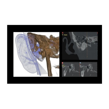 Hyperion X9 Pro 11x13 Ceph Titanium - дентальный цифровой 3D-томограф с цефалостатом, 3 в 1, FOV 11x13 Фото товара Hyperion X9 Pro 11x13 Ceph Titanium - дентальный цифровой 3D-томограф с цефалостатом, 3 в 1, FOV 11x13