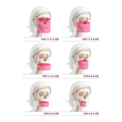 MyRay Hyperion X9 CB3D 11x13 Ceph Titanium - дентальный цифровой 3D-томограф с цефалостатом, 3 в 1, FOV 11x13 Фото товара MyRay Hyperion X9 CB3D 11x13 Ceph Titanium - дентальный цифровой 3D-томограф с цефалостатом, 3 в 1, FOV 11x13