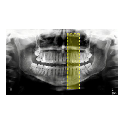 MyRay Hyperion X9 CB3D 11x13 Ceph Titanium - дентальный цифровой 3D-томограф с цефалостатом, 3 в 1, FOV 11x13 Фото товара MyRay Hyperion X9 CB3D 11x13 Ceph Titanium - дентальный цифровой 3D-томограф с цефалостатом, 3 в 1, FOV 11x13