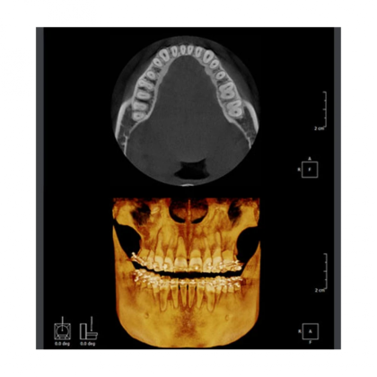 Фото товара RAYSCAN Symphony Alpha OCS – ортопантомограф c цефалостатом (One Shot), 30х25 см