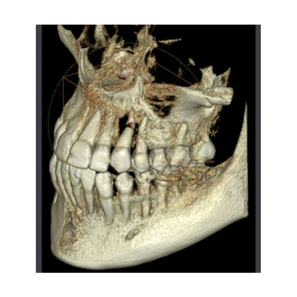 Фото товара RAYSCAN Symphony Alpha Plus 120 SM3D - ортопантомограф с цефалостатом 26х24 см и компьютерным томографом 3D (4х12)*(3х10) см