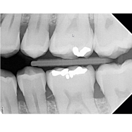 Фото товара Satelec Комплект рентген и визиограф - рентгеновский аппарат X-Mind DC 80 и визиограф Sopix2 (Франция)