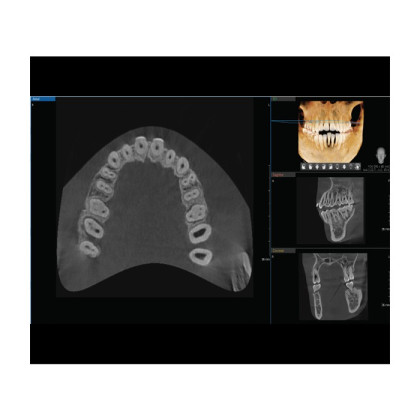 Vatech A9 RC - панорамный рентгеновский цифровой аппарат с функцией КТ, c цефалостатом, 10х8 Фото товара Vatech A9 RC - панорамный рентгеновский цифровой аппарат с функцией КТ, c цефалостатом, 10х8