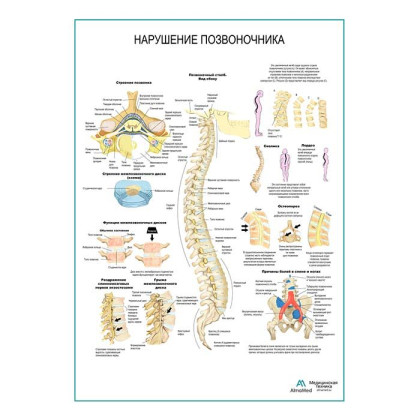 Фото товара Нарушения позвоночника плакат глянцевый А1+/А2+